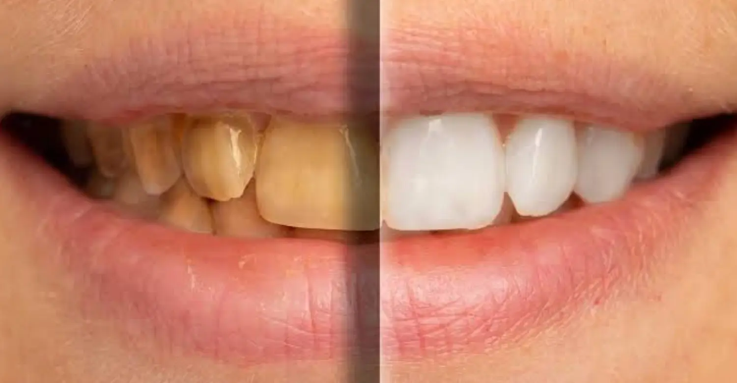 Yellow Teeth vs white teeth 2